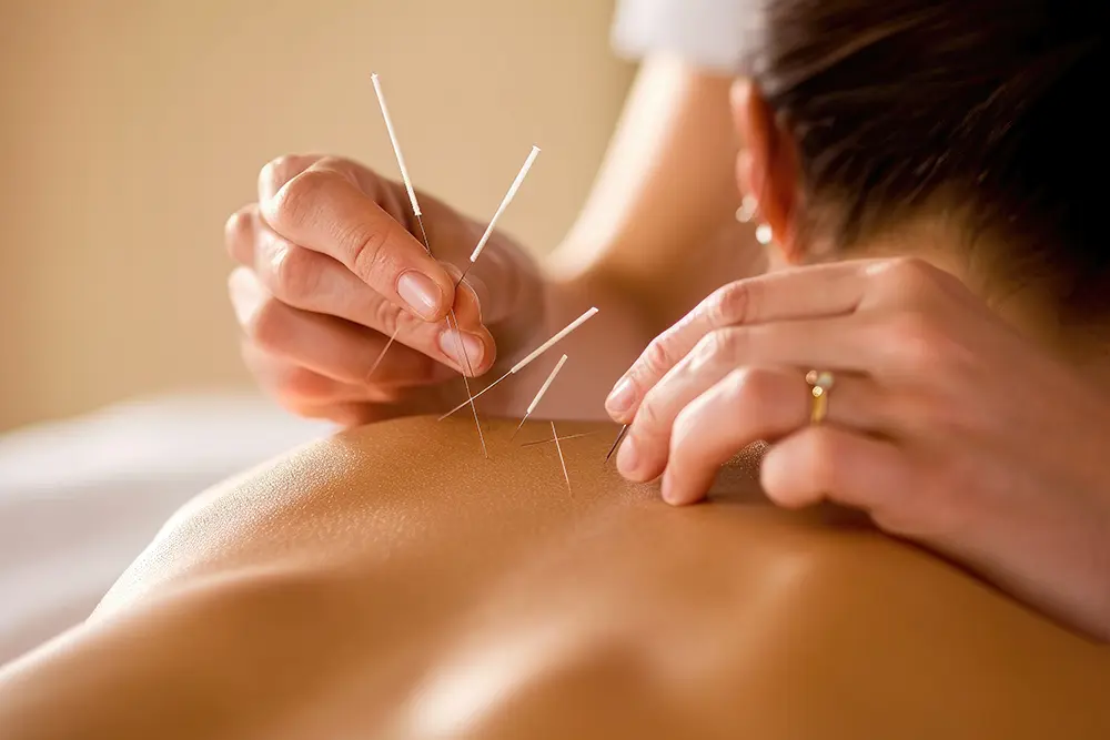 Dry Needling Tiefenentspannung der Kaumuskulatur